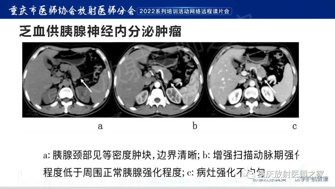 影像PPT - 【病例】肿块型胰腺炎1例CT及MR影像-21