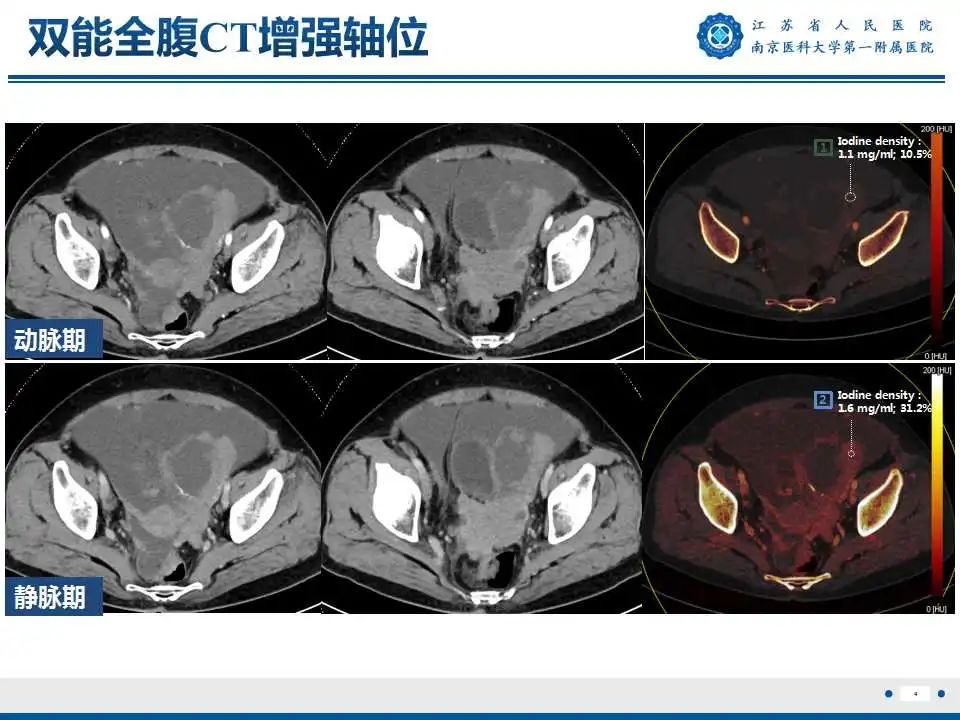 影像PPT - 【PPT】卵巢上皮癌-5