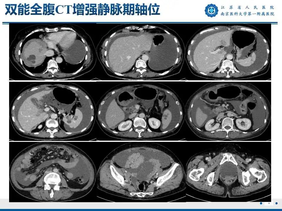 影像PPT - 【PPT】卵巢上皮癌-6