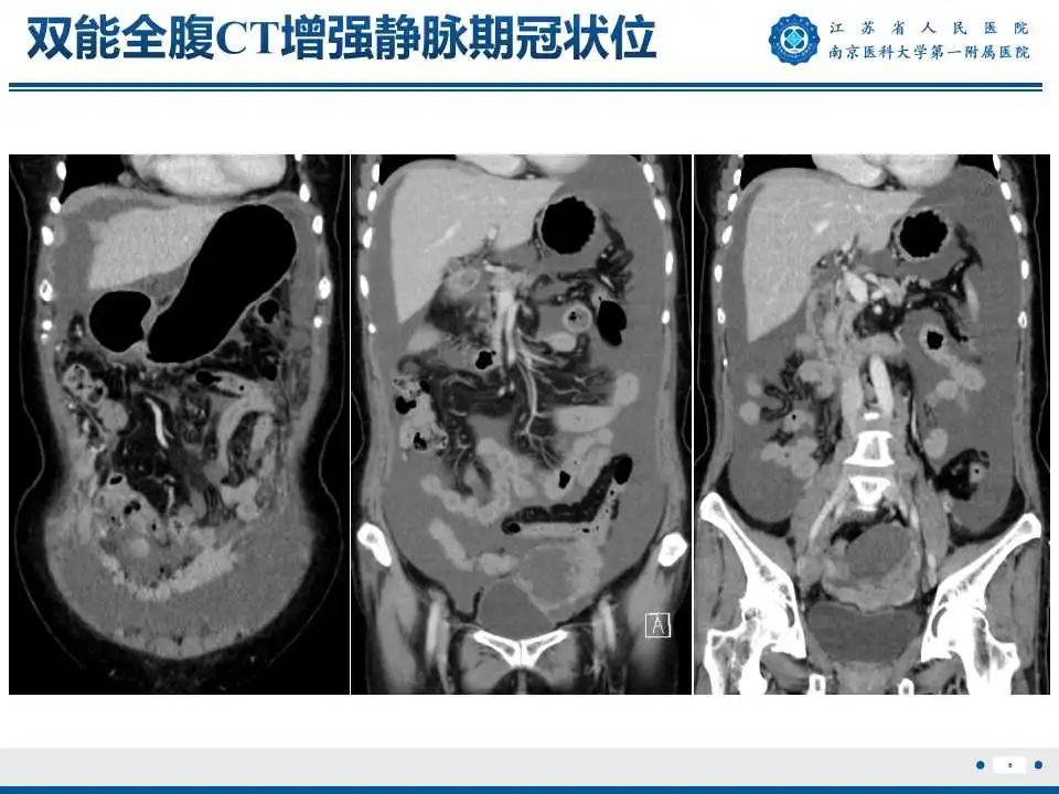 影像PPT - 【PPT】卵巢上皮癌-7