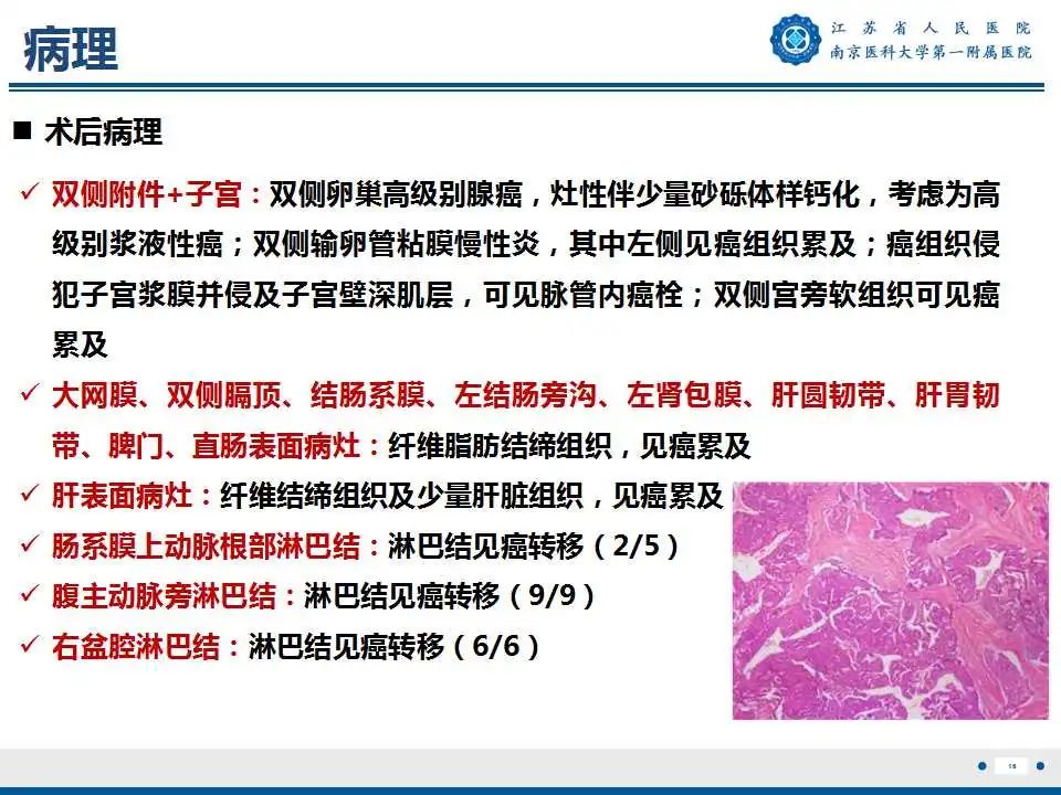 影像PPT - 【PPT】卵巢上皮癌-17