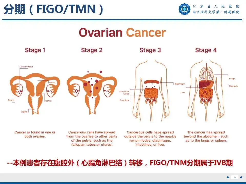 影像PPT - 【PPT】卵巢上皮癌-21