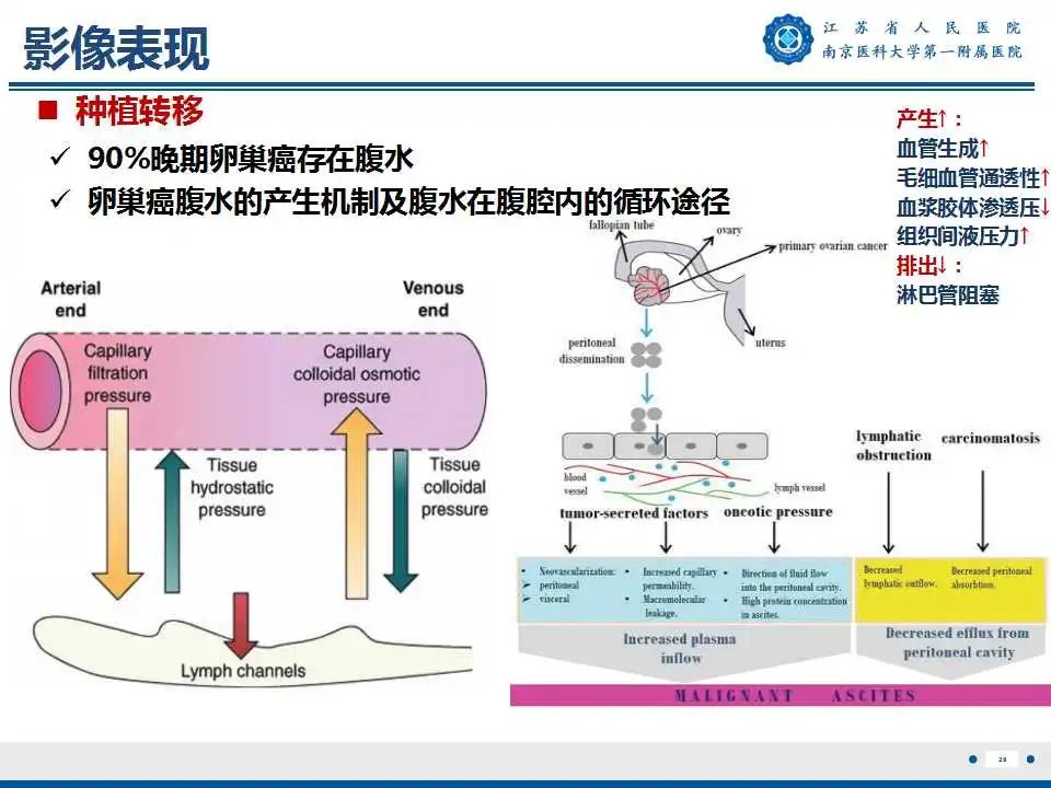 影像PPT - 【PPT】卵巢上皮癌-29