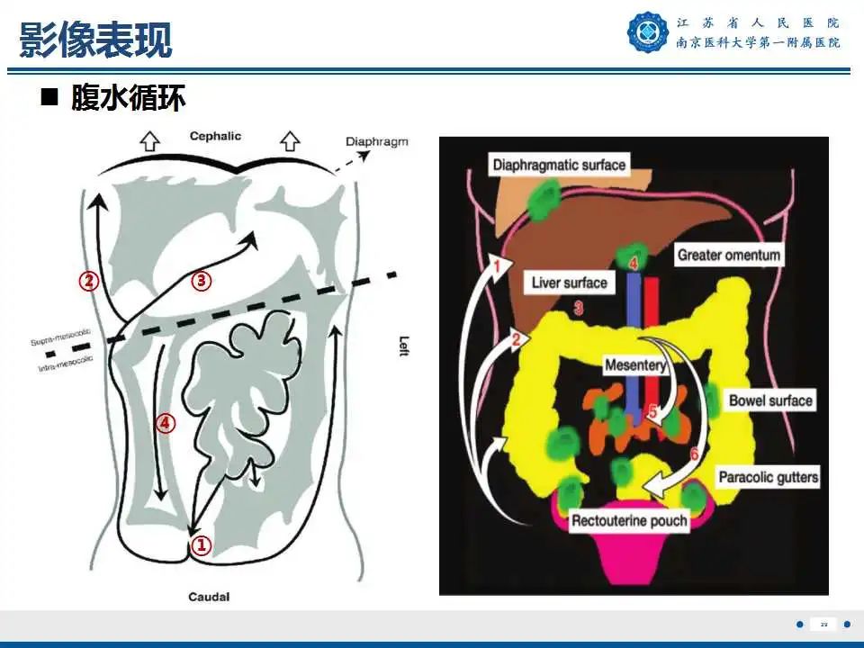 影像PPT - 【PPT】卵巢上皮癌-30