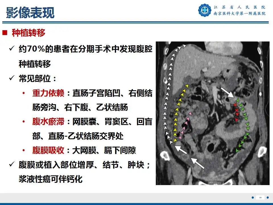 影像PPT - 【PPT】卵巢上皮癌-31