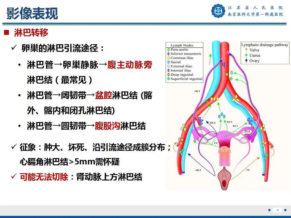 影像PPT - 【PPT】卵巢上皮癌-35