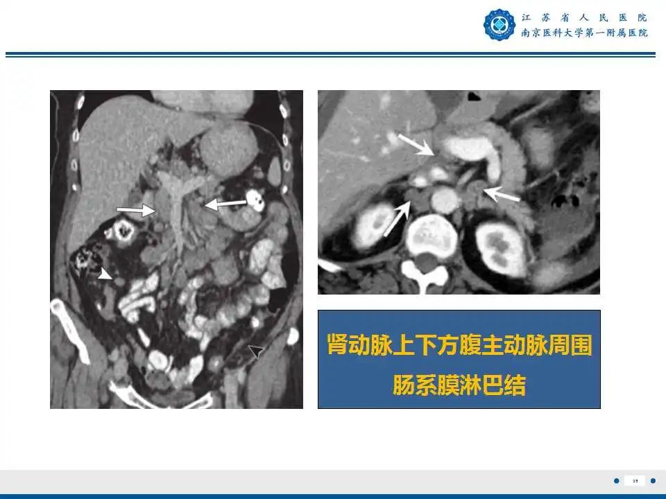 影像PPT - 【PPT】卵巢上皮癌-36