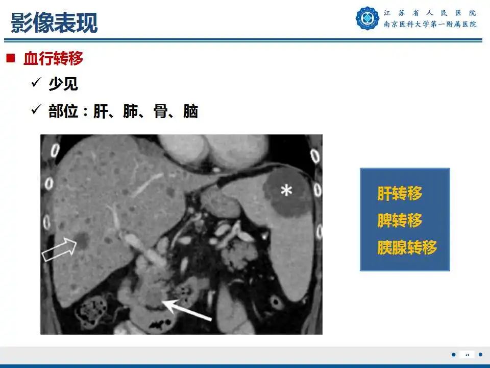 影像PPT - 【PPT】卵巢上皮癌-37