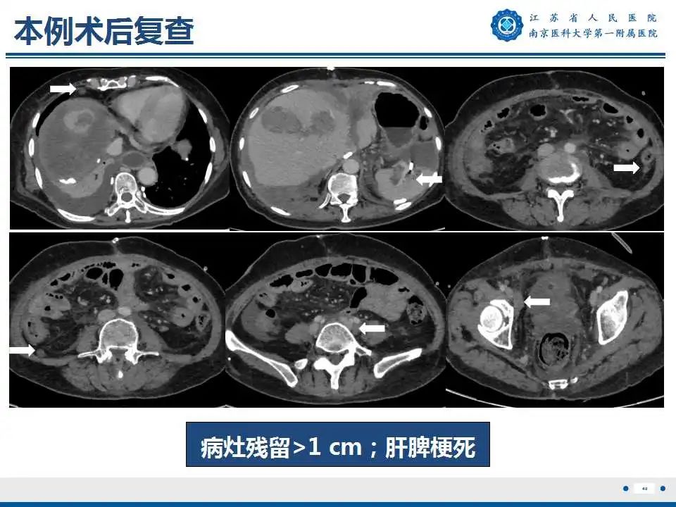 影像PPT - 【PPT】卵巢上皮癌-41