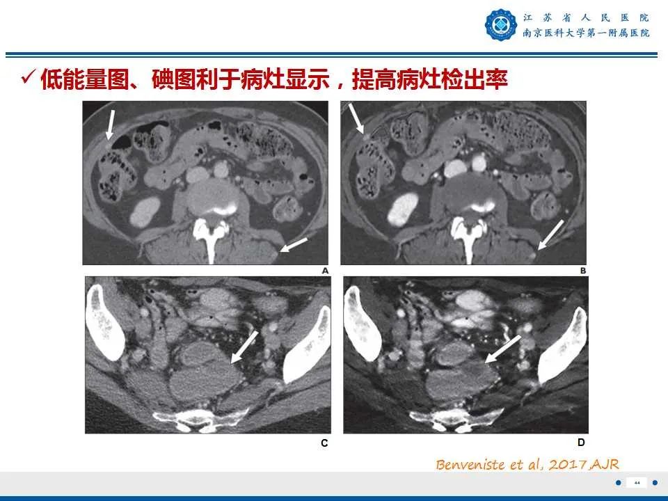 影像PPT - 【PPT】卵巢上皮癌-45