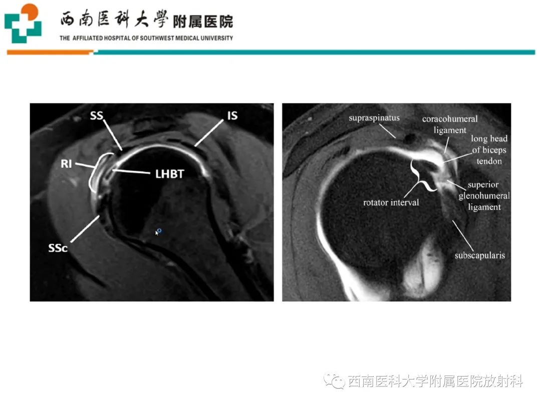 影像PPT - 【PPT】粘连性肩关节囊炎-12