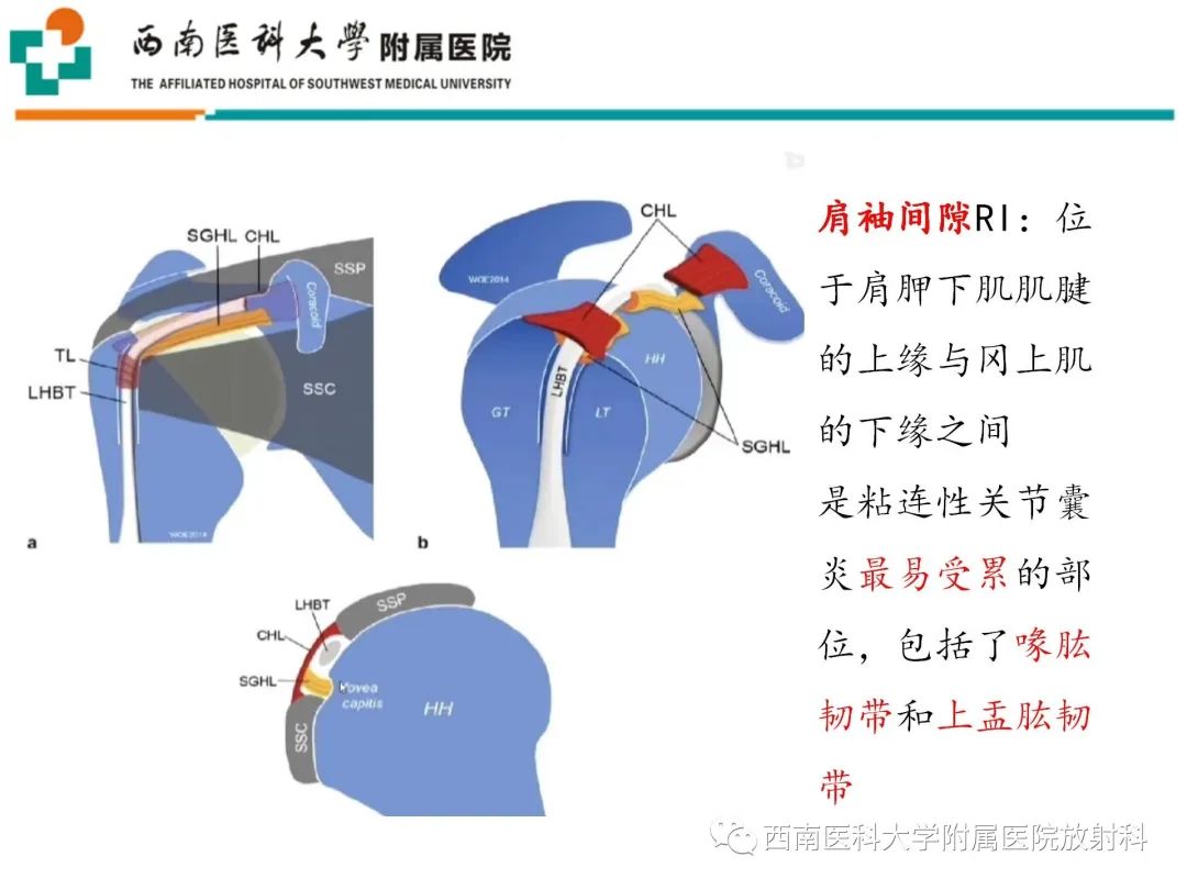 影像PPT - 【PPT】粘连性肩关节囊炎-11