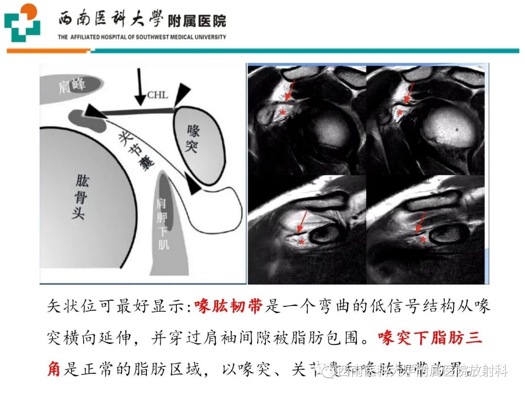 影像PPT - 【PPT】粘连性肩关节囊炎-13
