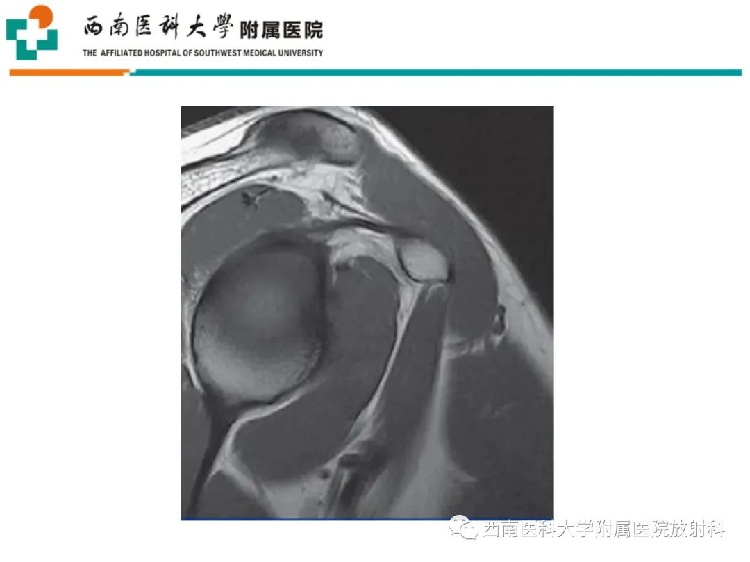影像PPT - 【PPT】粘连性肩关节囊炎-14