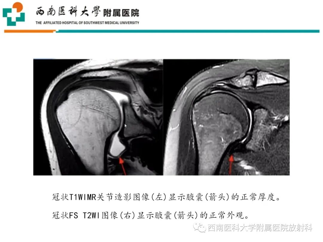 影像PPT - 【PPT】粘连性肩关节囊炎-17