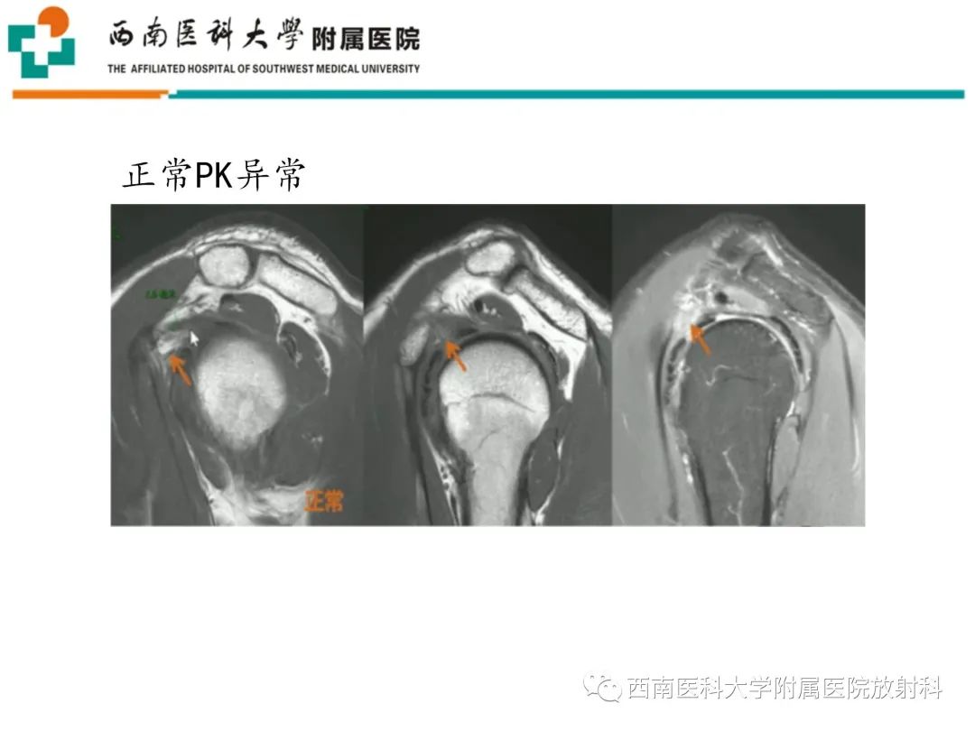 影像PPT - 【PPT】粘连性肩关节囊炎-18