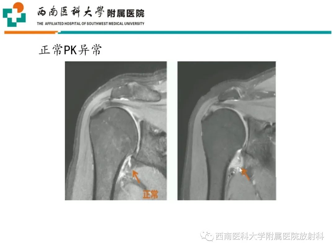 影像PPT - 【PPT】粘连性肩关节囊炎-19