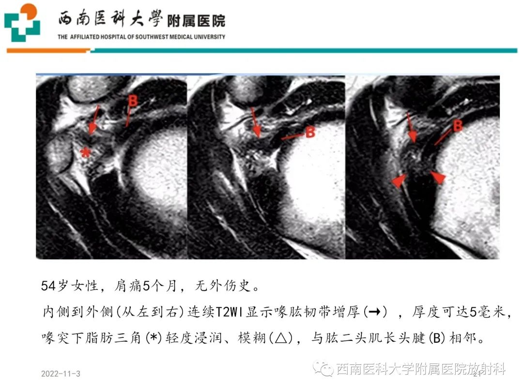 影像PPT - 【PPT】粘连性肩关节囊炎-21