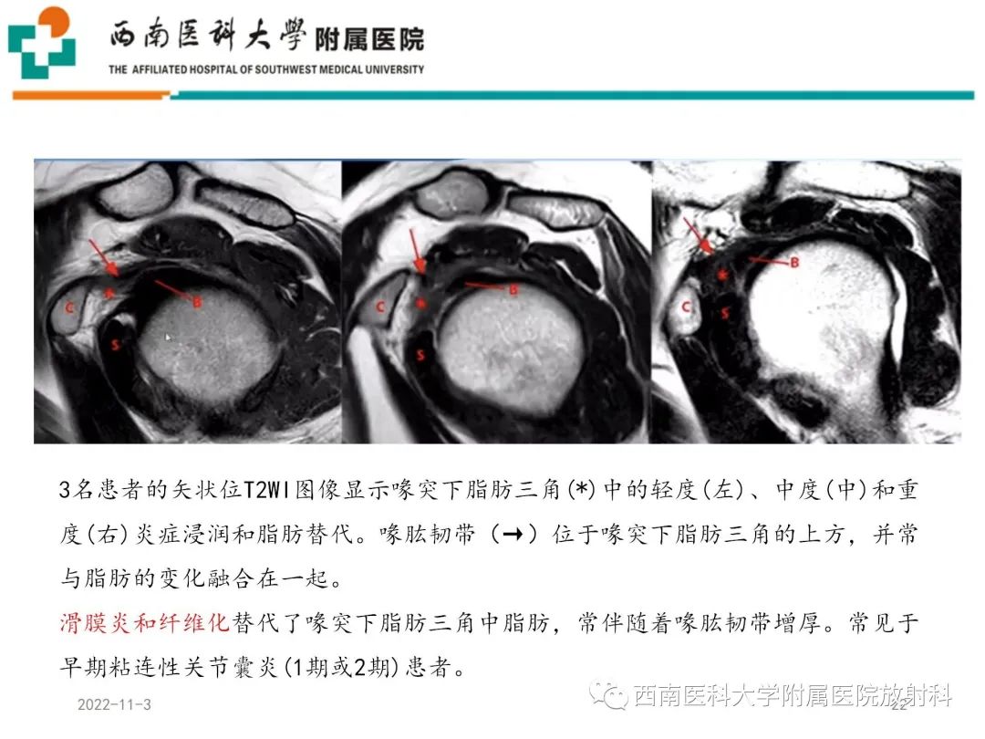 影像PPT - 【PPT】粘连性肩关节囊炎-22