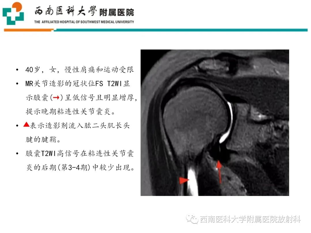 影像PPT - 【PPT】粘连性肩关节囊炎-24
