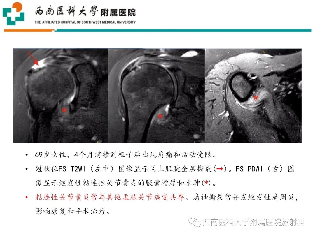 影像PPT - 【PPT】粘连性肩关节囊炎-25