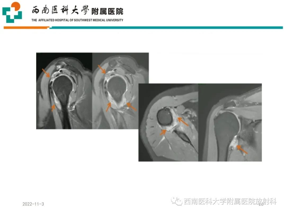 影像PPT - 【PPT】粘连性肩关节囊炎-26