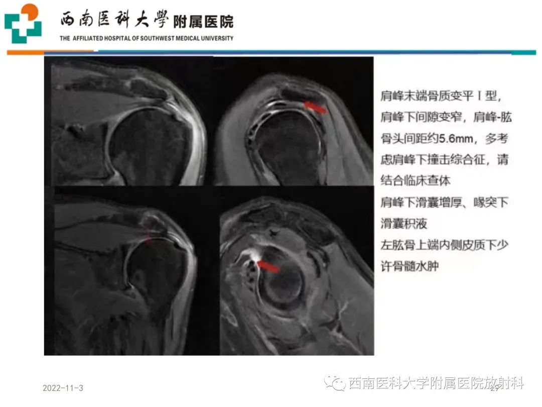 影像PPT - 【PPT】粘连性肩关节囊炎-29