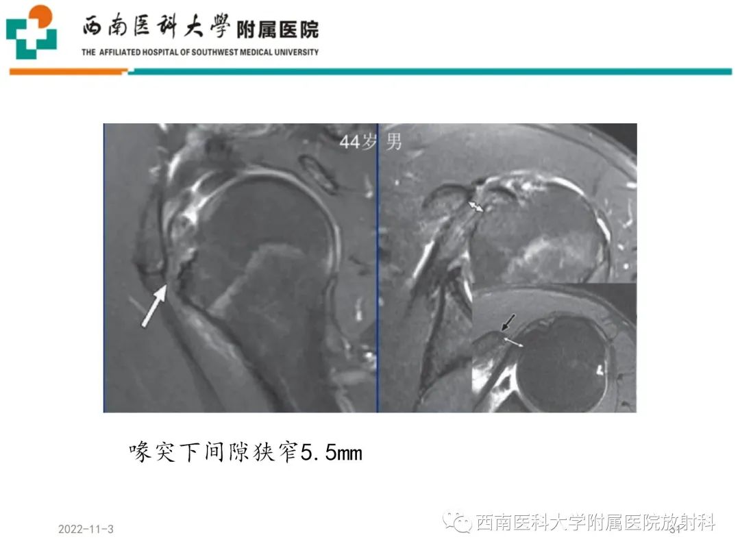 影像PPT - 【PPT】粘连性肩关节囊炎-31