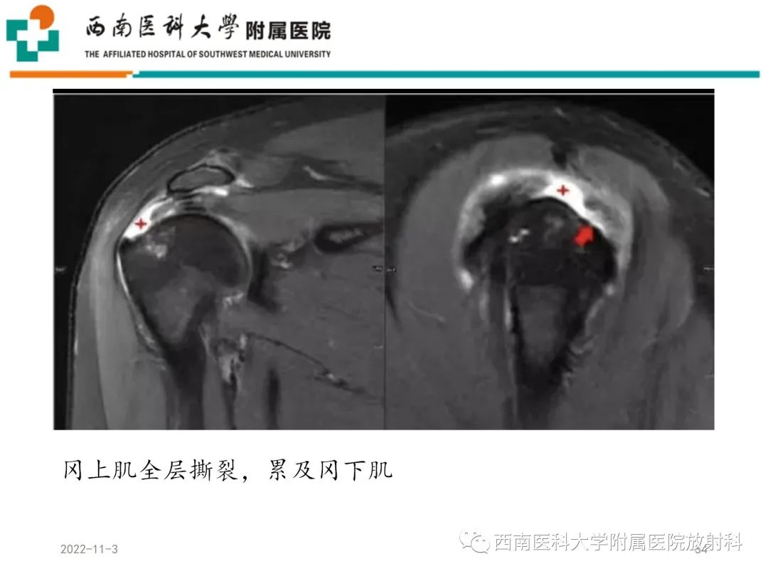 影像PPT - 【PPT】粘连性肩关节囊炎-34