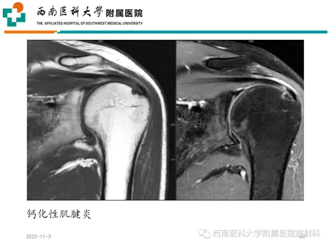 影像PPT - 【PPT】粘连性肩关节囊炎-35