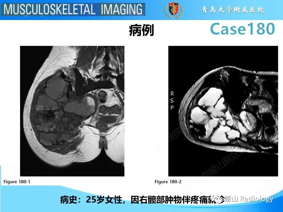 影像PPT - 【PPT】滑膜肉瘤-2