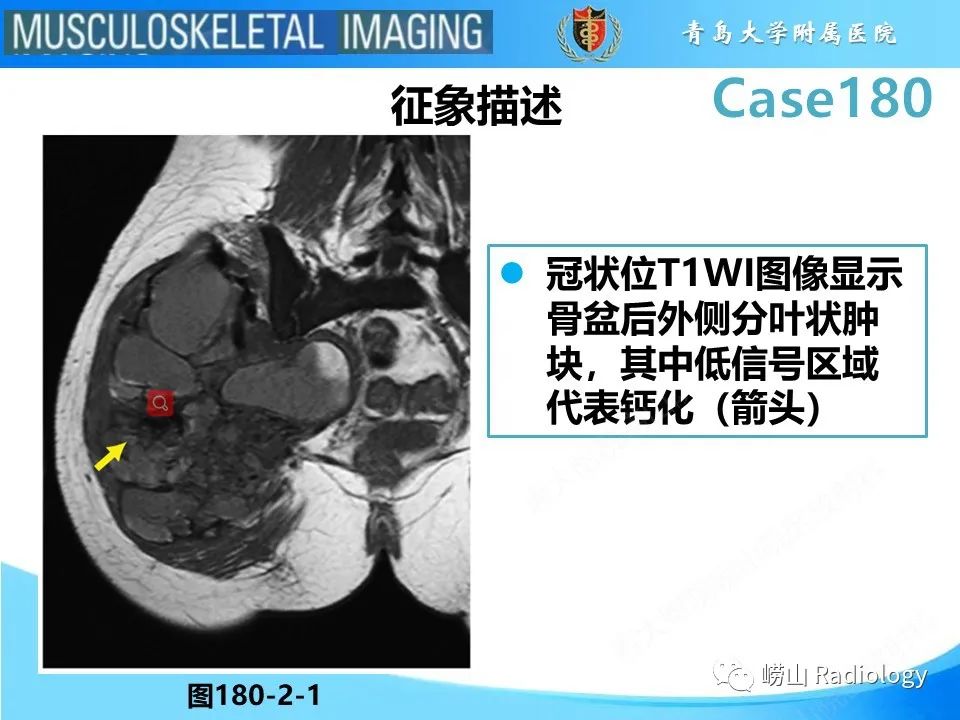 影像PPT - 【PPT】滑膜肉瘤-12