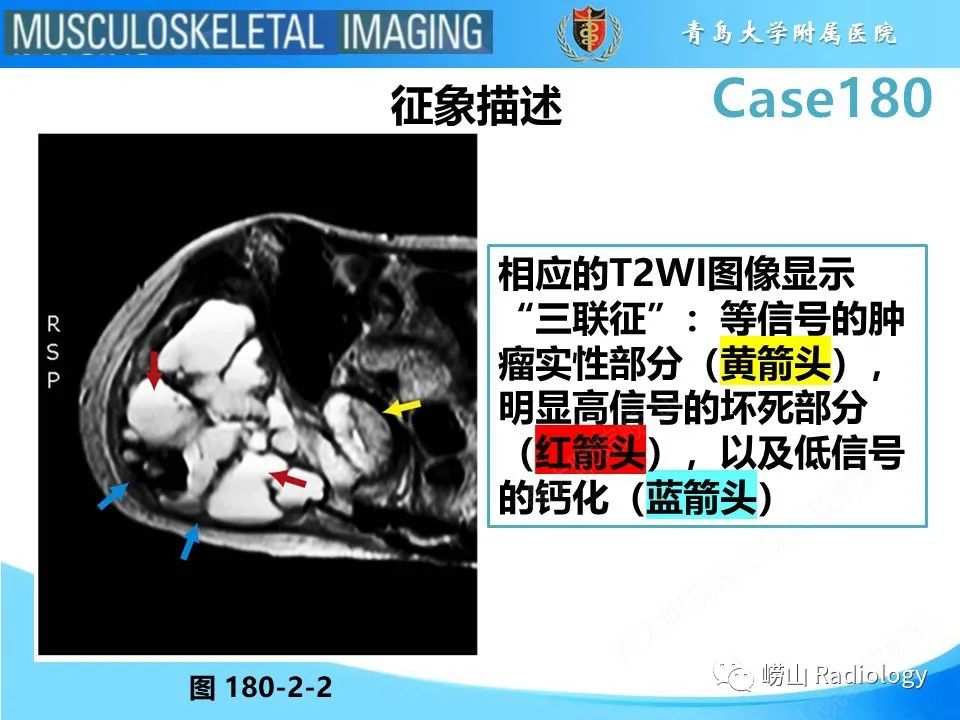 影像PPT - 【PPT】滑膜肉瘤-13