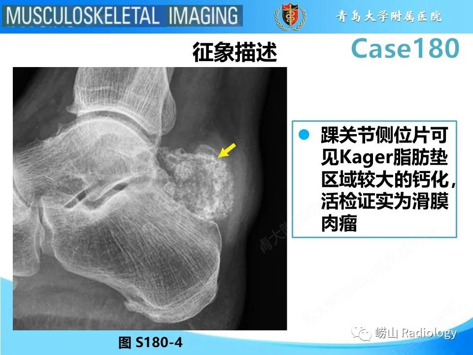 影像PPT - 【PPT】滑膜肉瘤-15