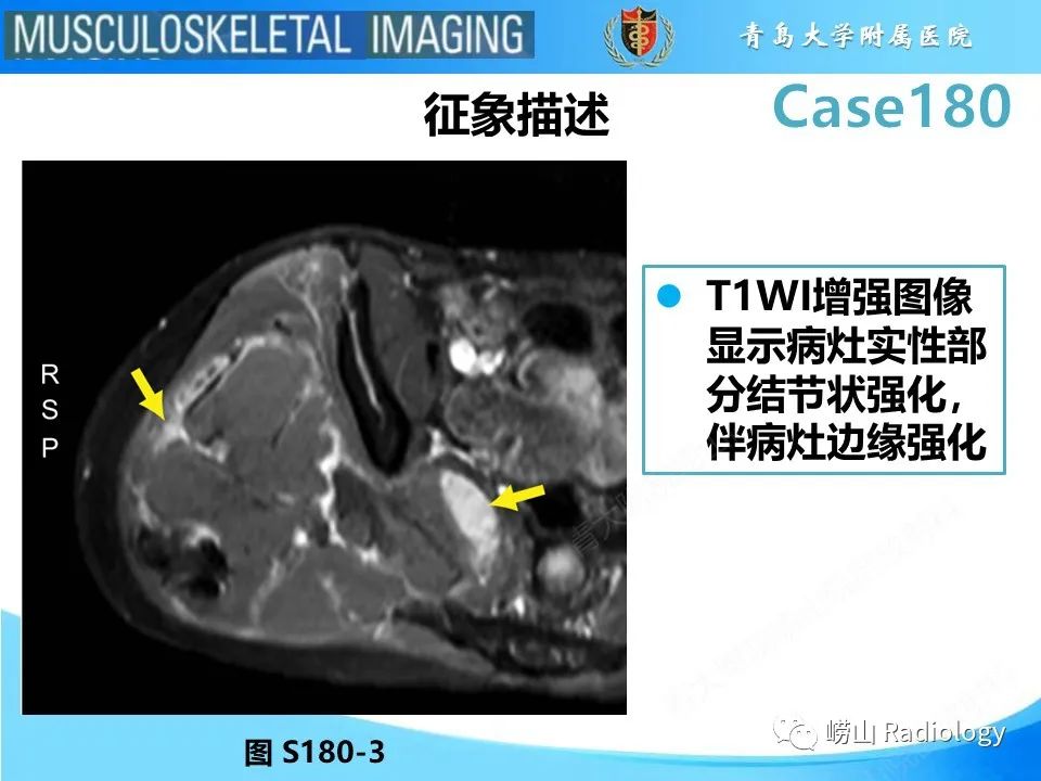 影像PPT - 【PPT】滑膜肉瘤-14