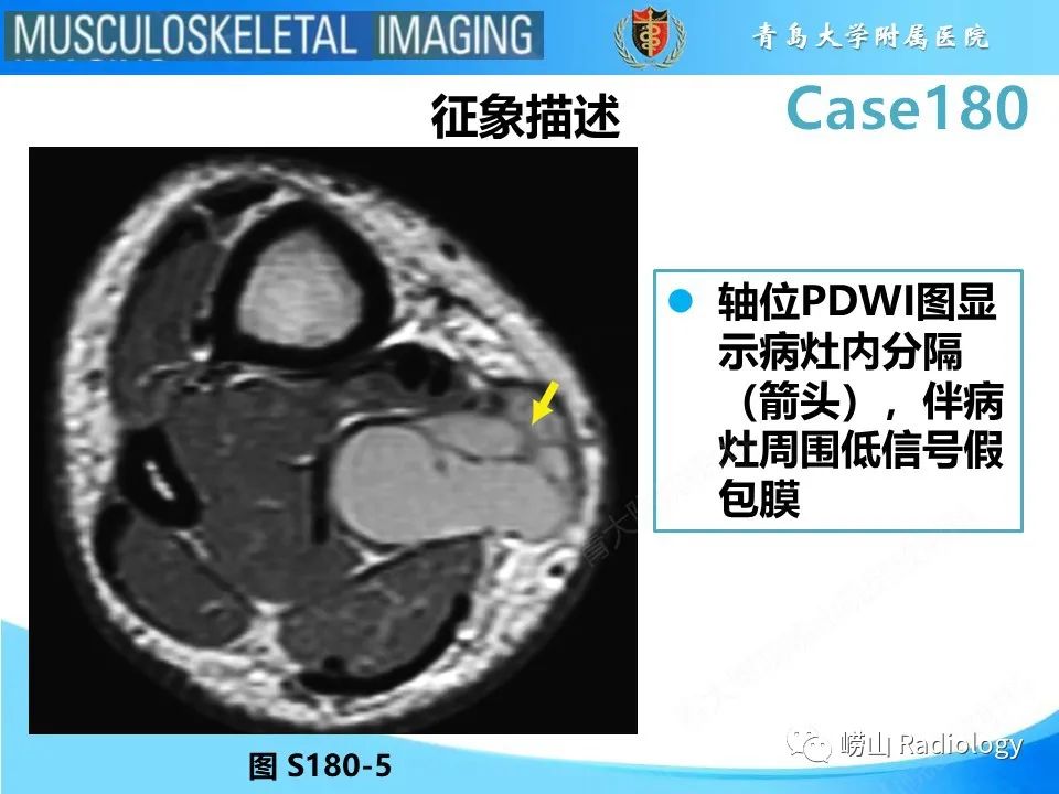 影像PPT - 【PPT】滑膜肉瘤-16