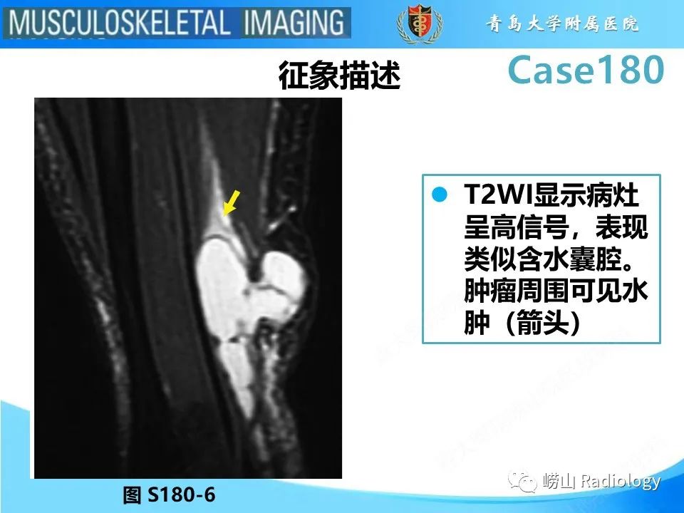 影像PPT - 【PPT】滑膜肉瘤-17