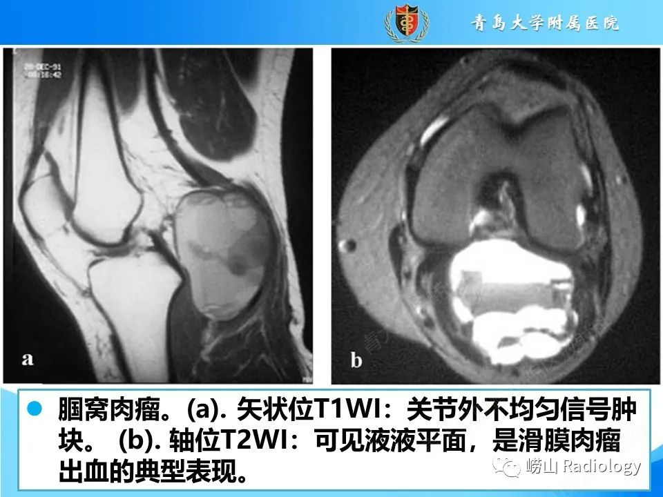 影像PPT - 【PPT】滑膜肉瘤-18