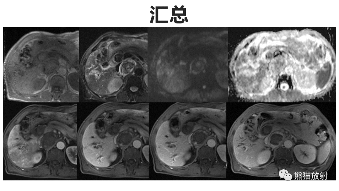 影像PPT - 【病例】腹膜后副神经节瘤 VS 神经鞘瘤-6