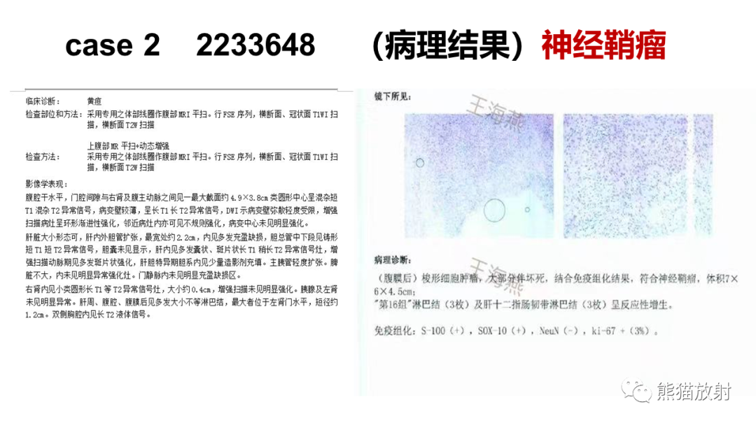 影像PPT - 【病例】腹膜后副神经节瘤 VS 神经鞘瘤-10
