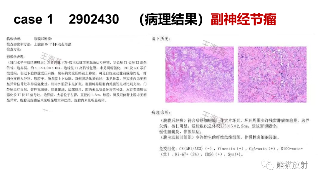 影像PPT - 【病例】腹膜后副神经节瘤 VS 神经鞘瘤-9