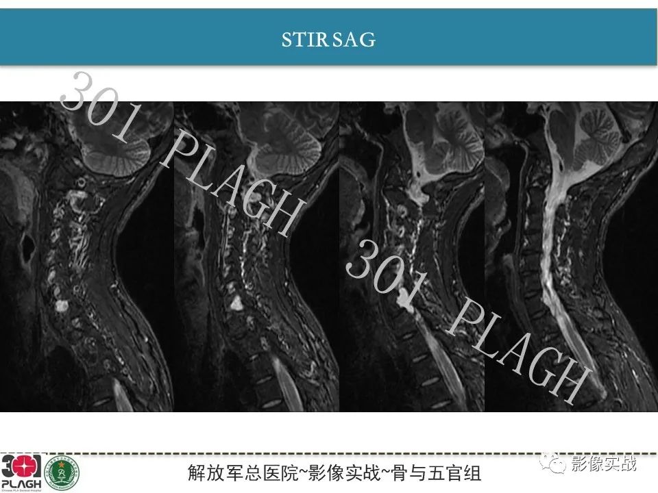 影像PPT - 【病例】颈椎脊索瘤1例MR影像-5