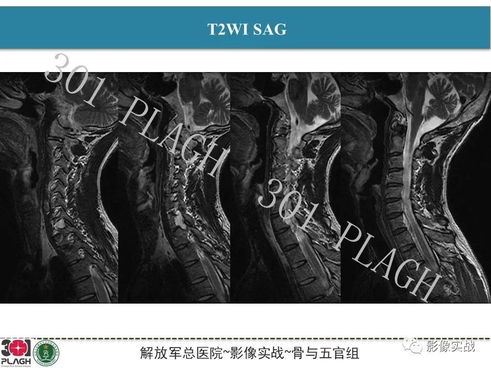 影像PPT - 【病例】颈椎脊索瘤1例MR影像-4