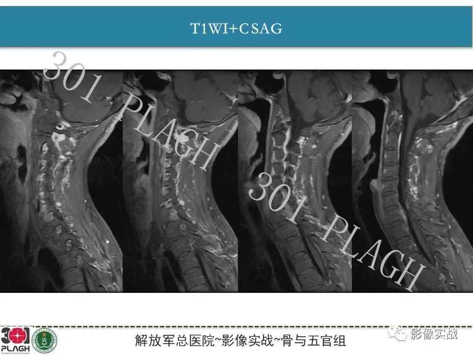 影像PPT - 【病例】颈椎脊索瘤1例MR影像-8
