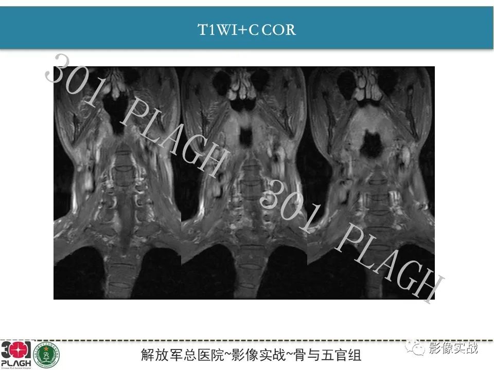 影像PPT - 【病例】颈椎脊索瘤1例MR影像-9