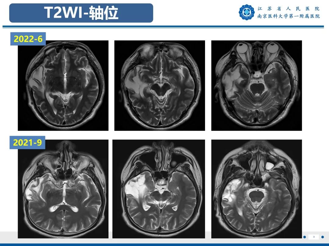 影像PPT - 【PPT】​海马硬化-4