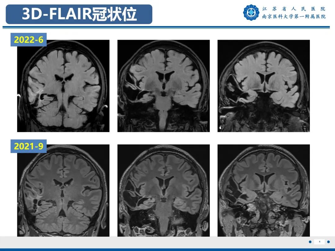 影像PPT - 【PPT】​海马硬化-5