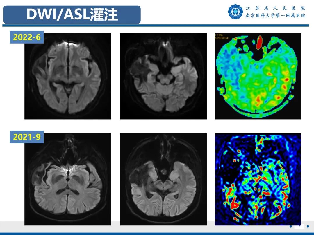 影像PPT - 【PPT】​海马硬化-7