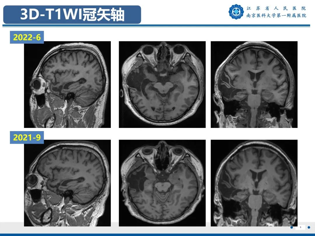 影像PPT - 【PPT】​海马硬化-6