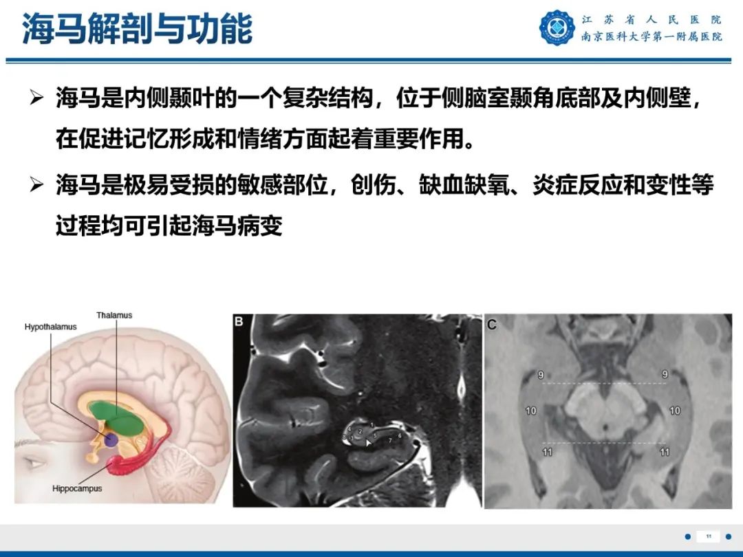 影像PPT - 【PPT】​海马硬化-12